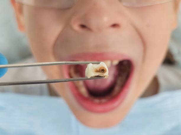 Best Dental Abscess Treatment in Centerfield, UT